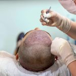 Hair Transplant Is Safe: Complications, Risks, And Advantages
