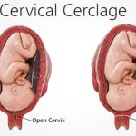 things not to do after cervical cerclage