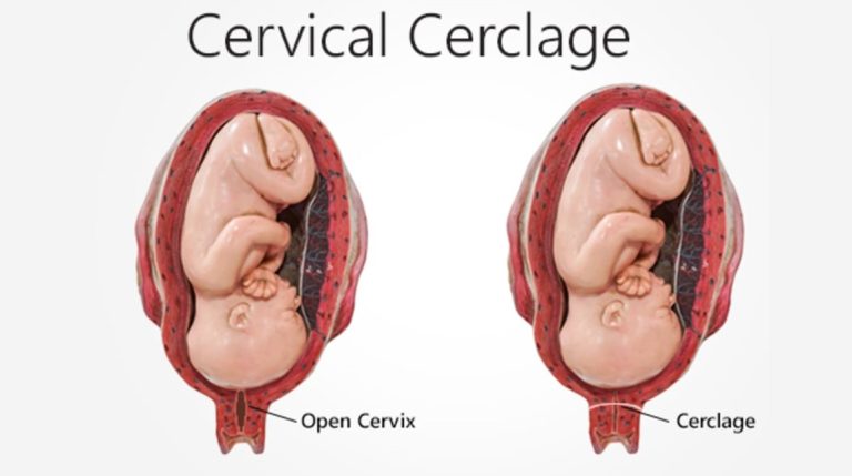Things Not To Do After Cervical Cerclage – 10 Must Follow Precautions